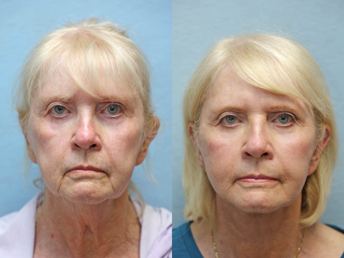 facelift and neck lift before and after right