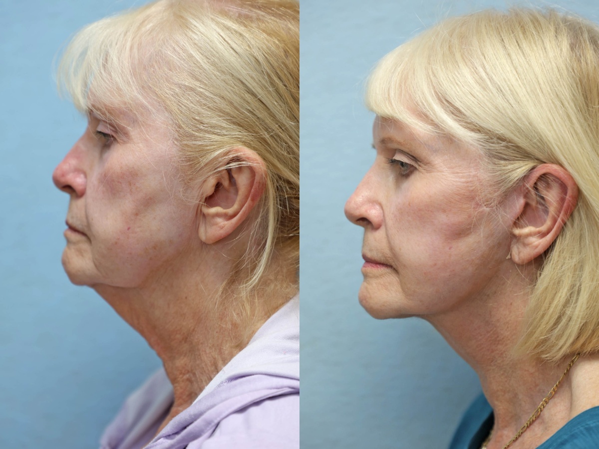 facelift and neck lift before and after left