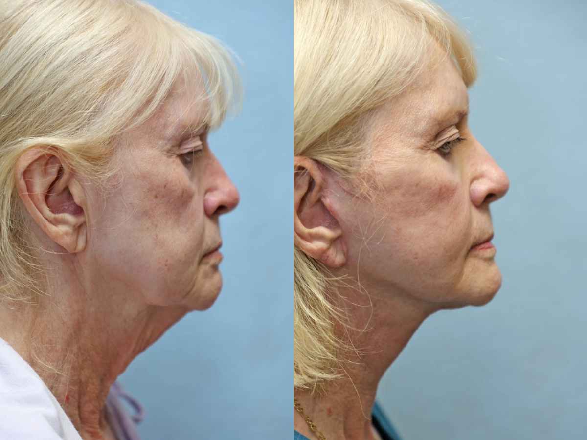 facelift and neck lift before and after left