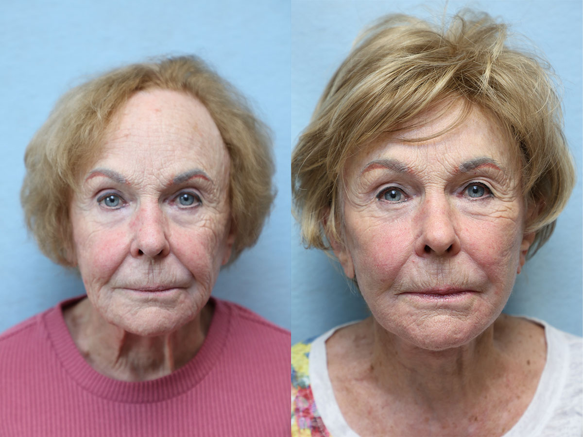 facelift and neck lift before and after right