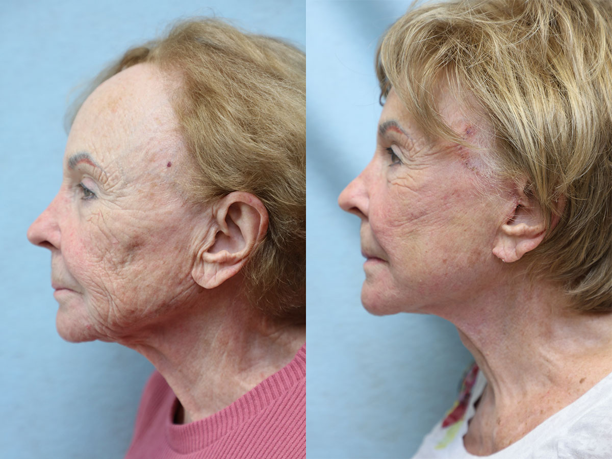 facelift and neck lift before and after left