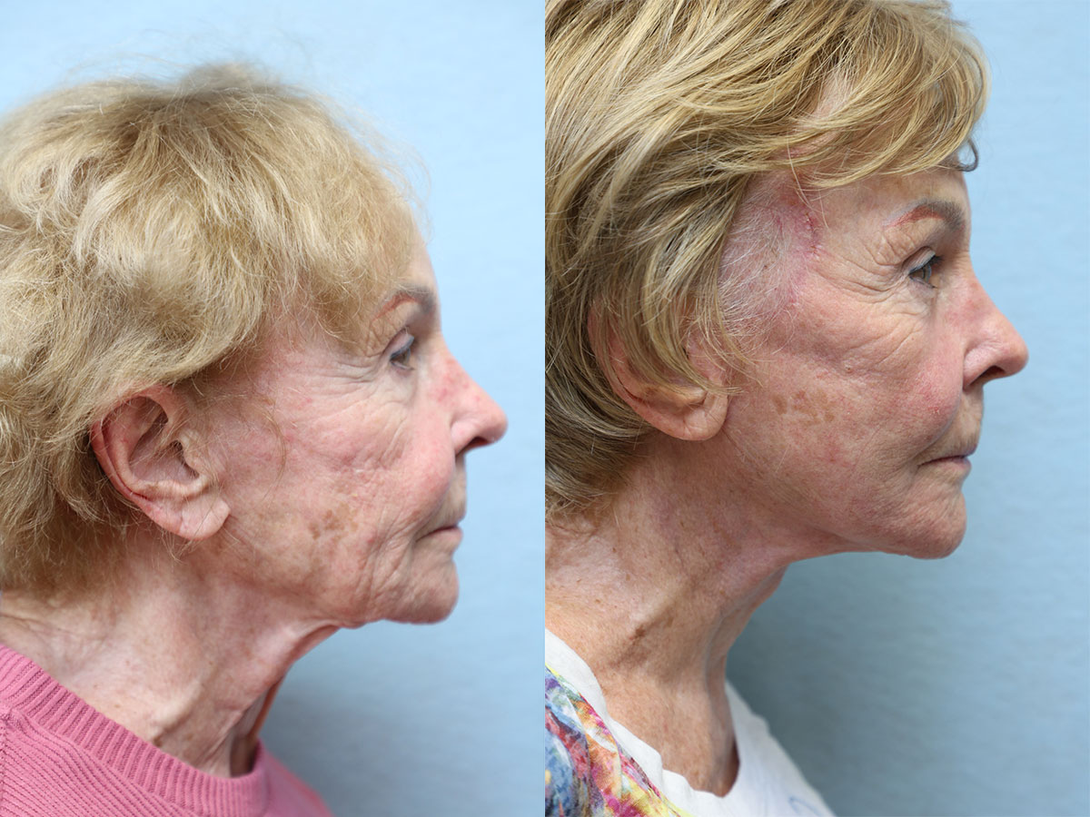 facelift and neck lift before and after left