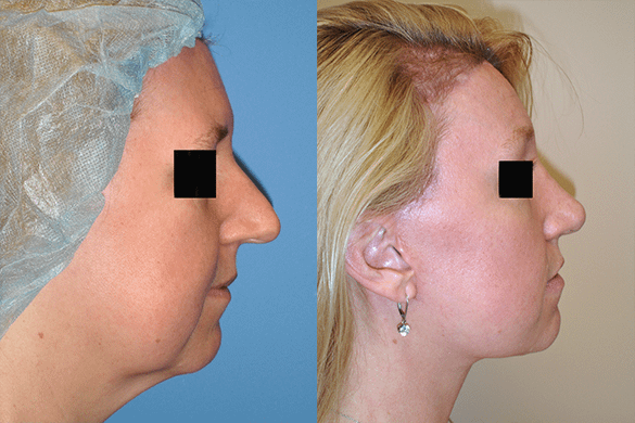 Face and Neck Lift Before & After Photos Right