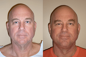 Face and Neck Lift Before & After Photos Front