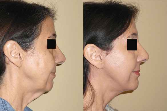 Face and Neck Lift Before & After Photos Right