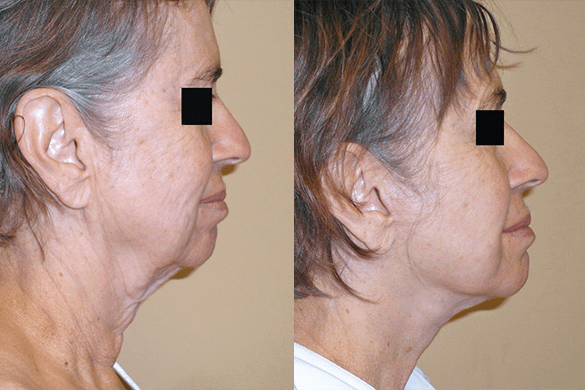Face and Neck Lift Before & After Photos Right