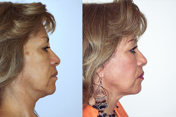 Face and Neck Lift Before & After Photos Right