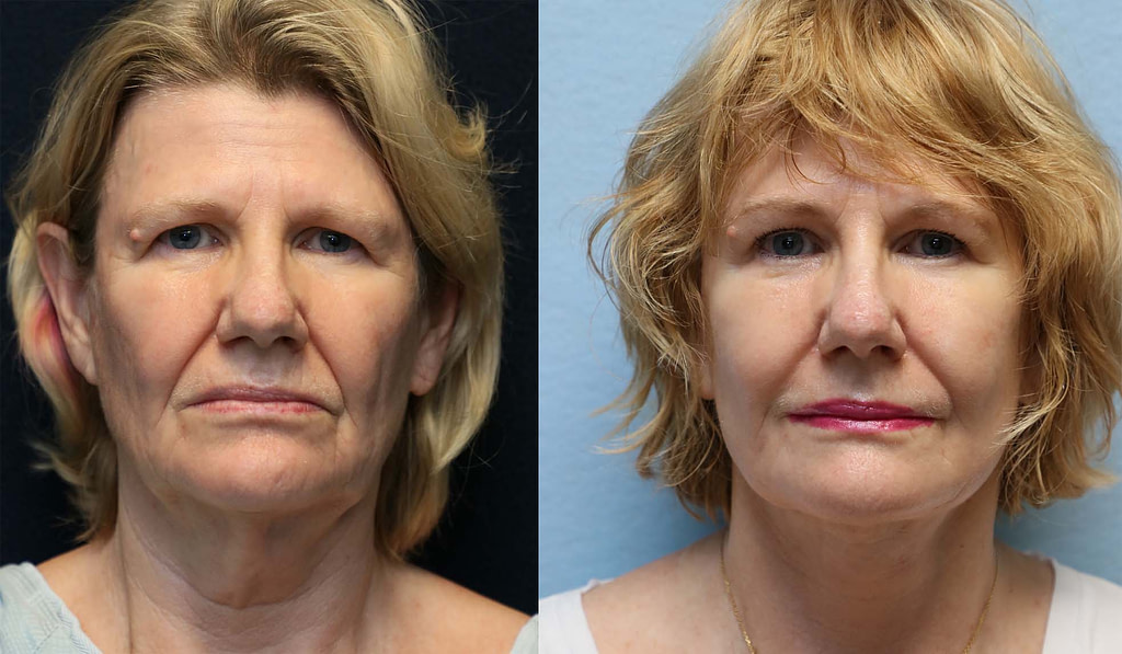 face lift neck lift front