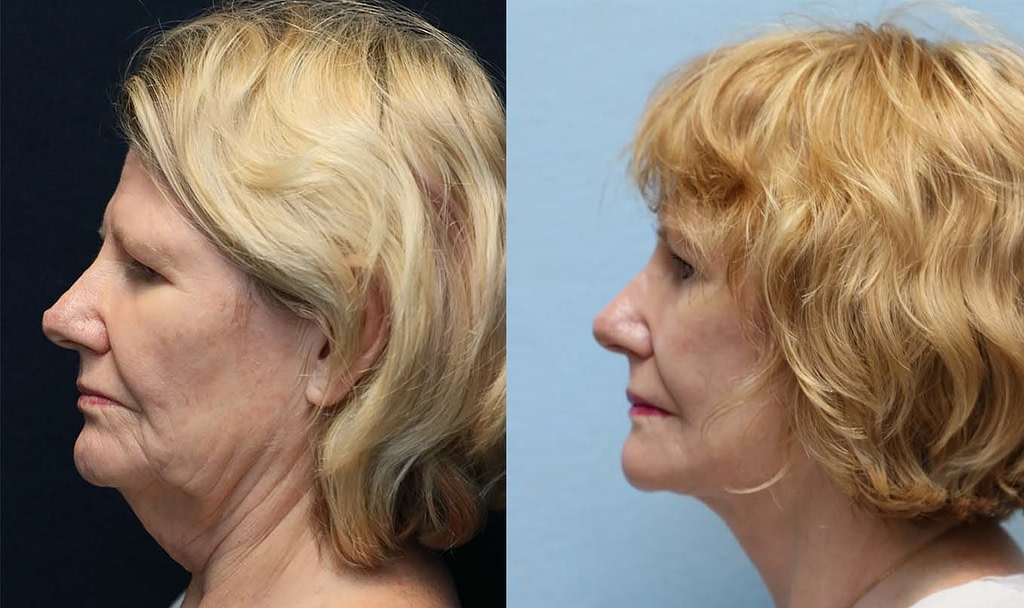 face lift neck lift left