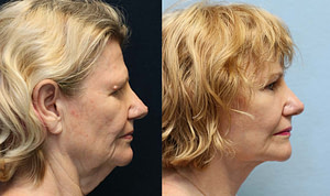 face lift neck lift right