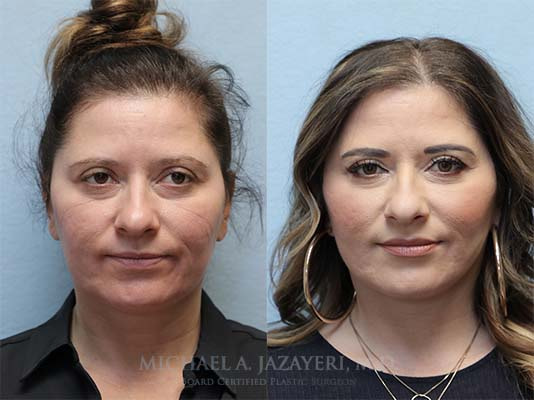 facelift and neck lift before and after