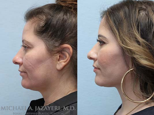facelift and neck lift before and after
