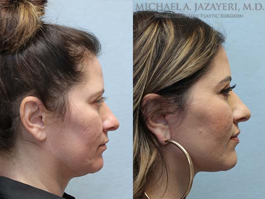 facelift and neck lift before and after