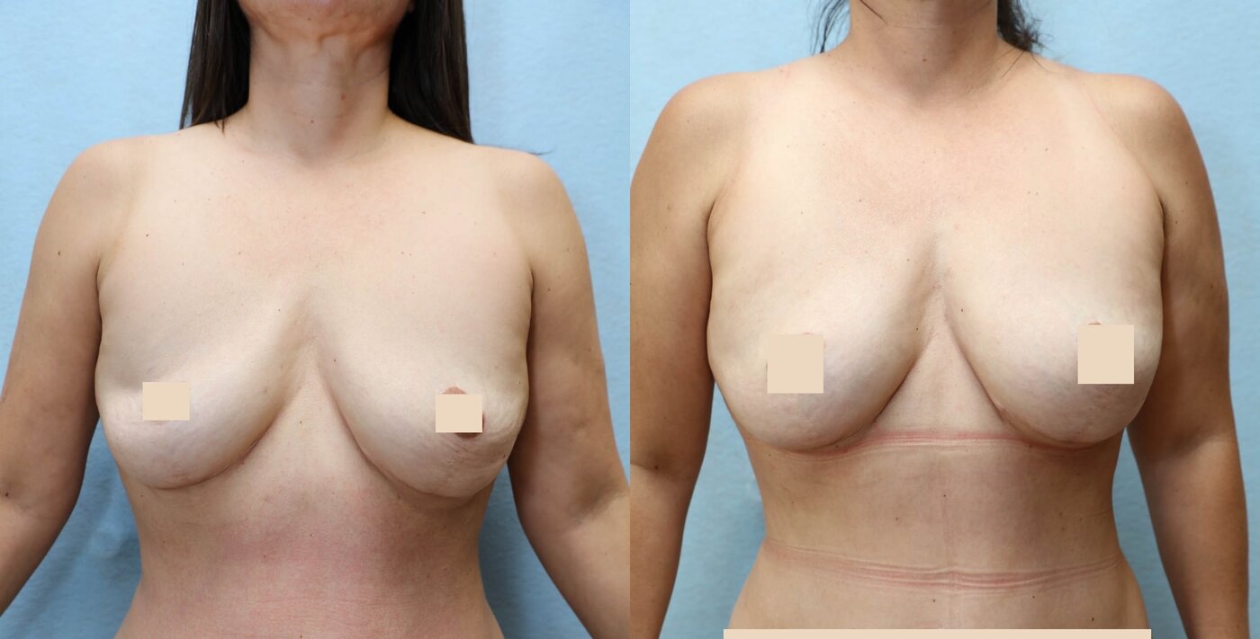 Fat Transfer to Breast before and after