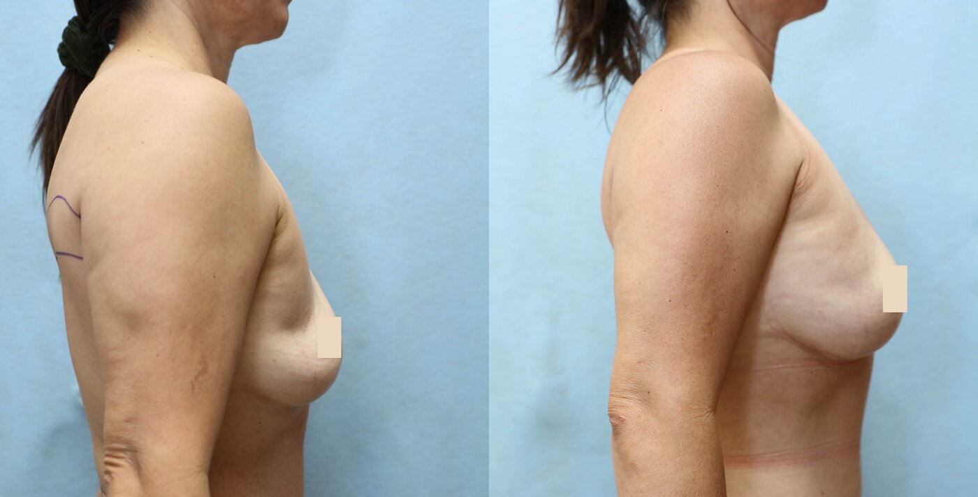 Fat Transfer to Breast before and after