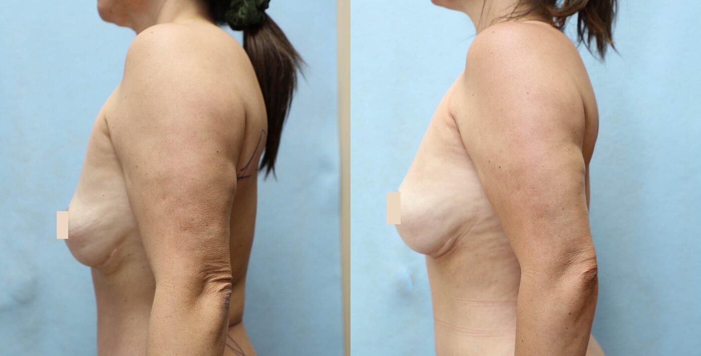 Fat Transfer to Breast before and after