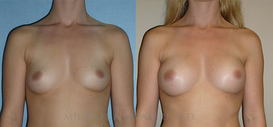 Fat Transfer to Breasts Before & After