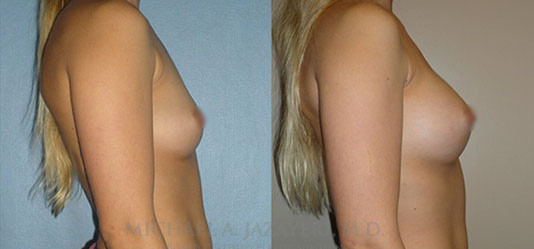 Fat Transfer to Breasts before and after