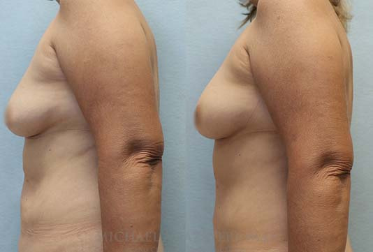Fat Transfer to Breasts before and after