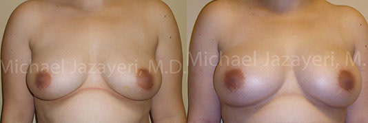 Fat Transfer to Breasts before and after