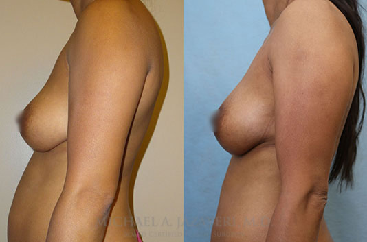 Fat Transfer to Breast before and after