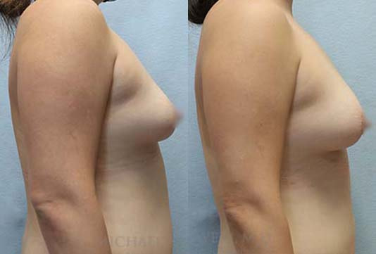 Fat Transfer to Breasts Before & After right