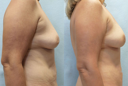 Fat Transfer to Breasts before and after