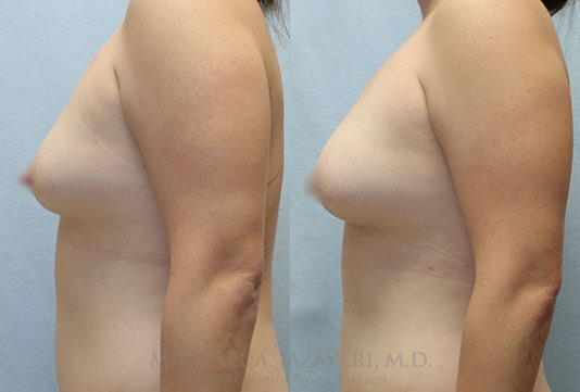 Fat Transfer to Breasts before and after
