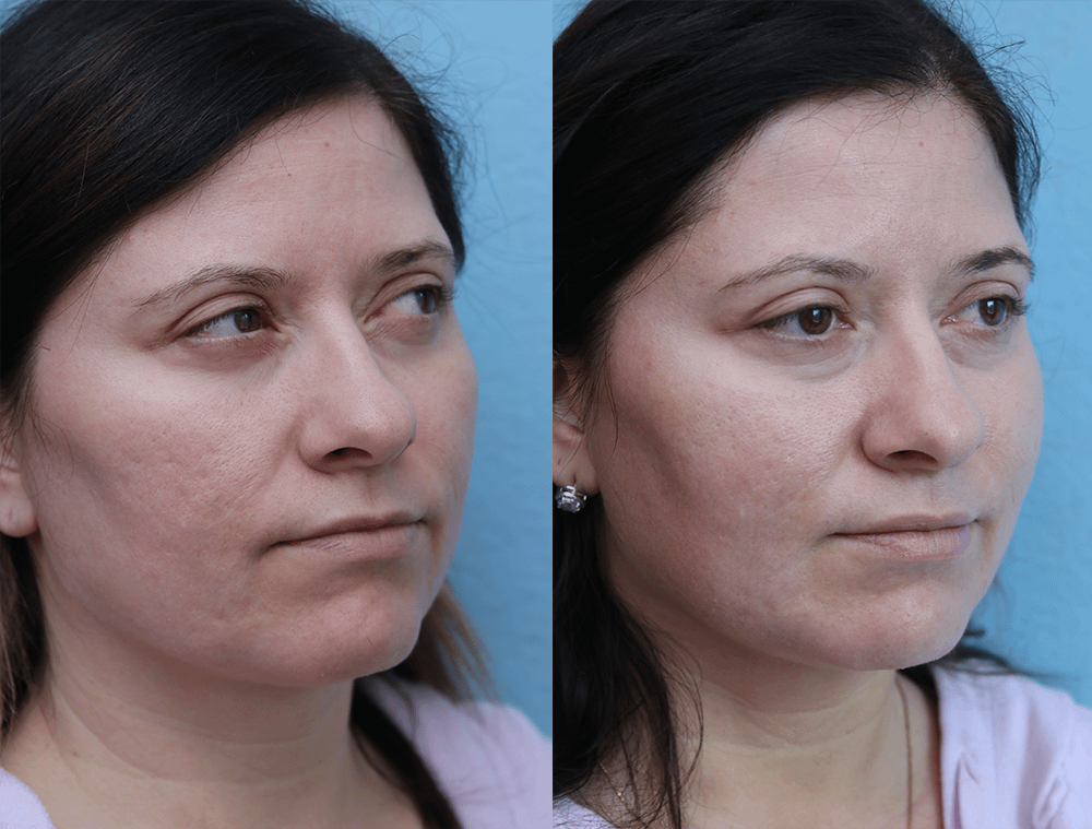 Fat Transfer to Face Results | Dr. Michael Jazayeri