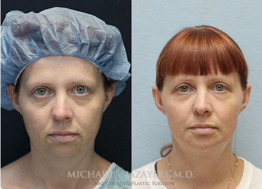 facelift and neck lift before and after front