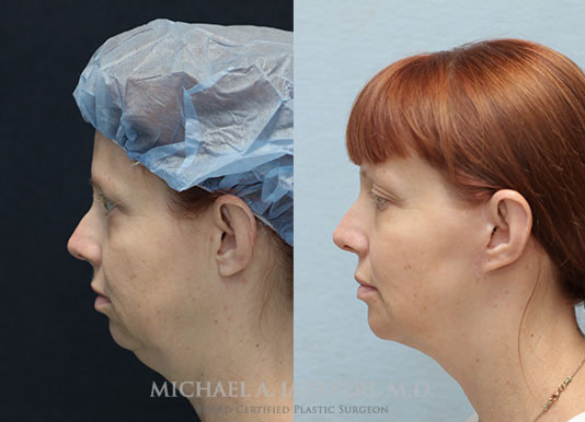 facelift and neck lift before and after left