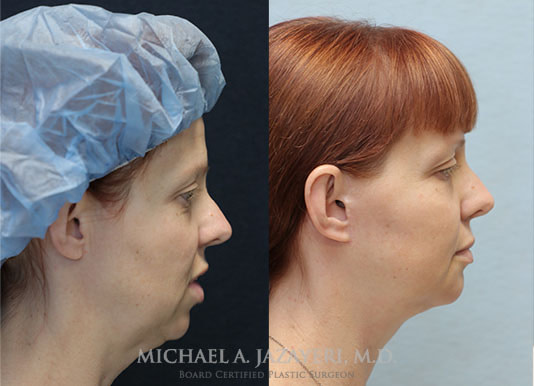 facelift and neck lift before and after right