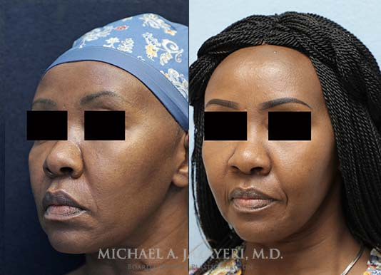 fat transfer to face before and after