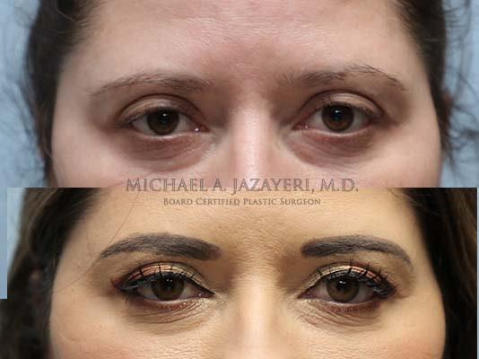fat transfer to under eye