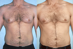 Gynecomastia (Male Breast Reduction)Before & After Photos