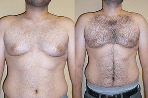 Gynecomastia (Male Breast Reduction) Before & After Photos