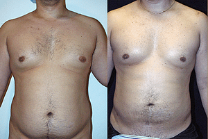 Gynecomastia (Male Breast Reduction) Before & After Photos