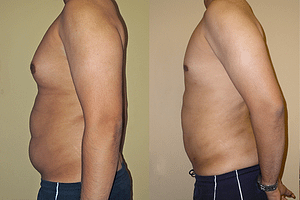 Gynecomastia (Male Breast Reduction) Before & After Photos