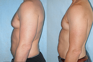 Gynecomastia (Male Breast Reduction) Before & After Photos