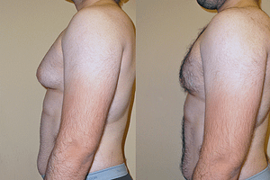 Gynecomastia (Male Breast Reduction) Before & After Photos