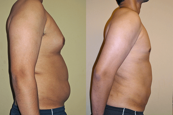 Gynecomastia (Male Breast Reduction) Before & After Photos