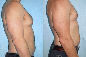 Gynecomastia (Male Breast Reduction) Before & After Photos