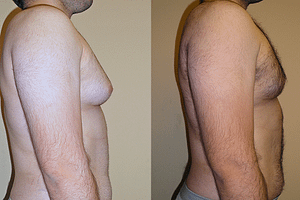 Gynecomastia (Male Breast Reduction) Before & After Photos