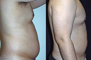 Gynecomastia (Male Breast Reduction) Before & After Photos
