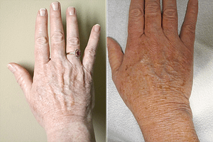 Hand Rejuvenation Before & After Photos Right Side