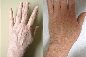 Hand Rejuvenation Before & After Photos Left Side