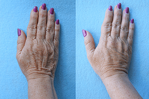 Hand Rejuvenation Before & After Photos Right Side