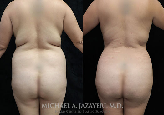 Buttock augmentation before and after