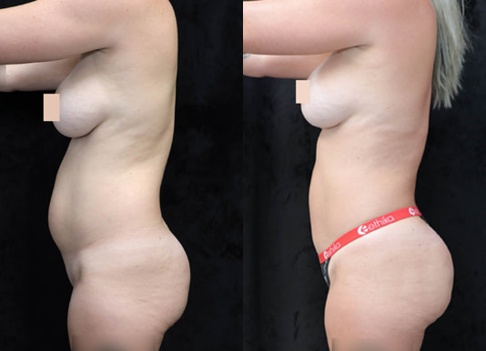 Brazilian Butt Lift Before & After Photos