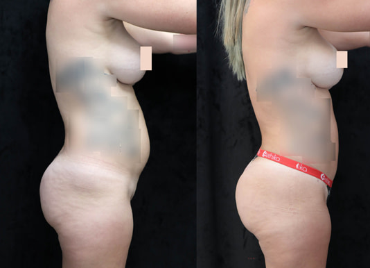 Brazilian Butt Lift Before & After Photos